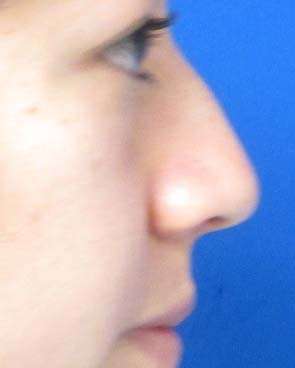 Rhinoplasty Before & After Patient #10207