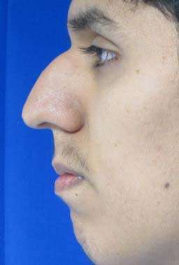 Rhinoplasty Before & After Patient #10210
