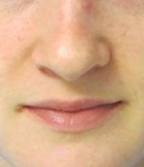 Rhinoplasty Before & After Patient #10213