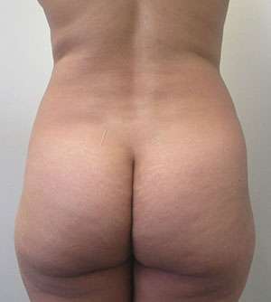 Brazilian Butt Lift Before & After Patient #6332