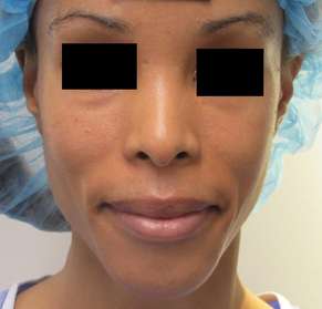 Rhinoplasty Before & After Patient #10222