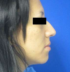 Rhinoplasty Before & After Patient #10225