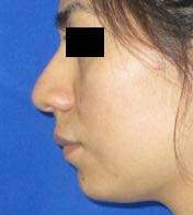 Rhinoplasty Before & After Patient #10228