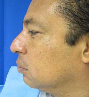 Rhinoplasty Before & After Patient #10231