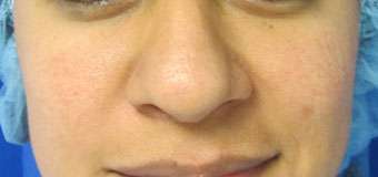 Rhinoplasty Before & After Patient #10234