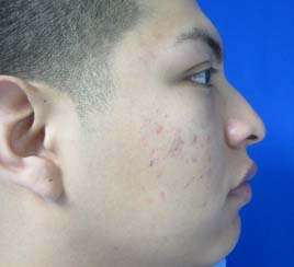 Rhinoplasty Before & After Patient #10242