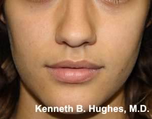 Rhinoplasty Before & After Patient #10245