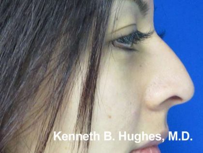 Rhinoplasty Before & After Patient #10250