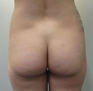 Brazilian Butt Lift Before & After Patient #6335