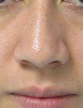 Rhinoplasty Before & After Patient #10253