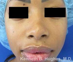 Rhinoplasty Before & After Patient #10256