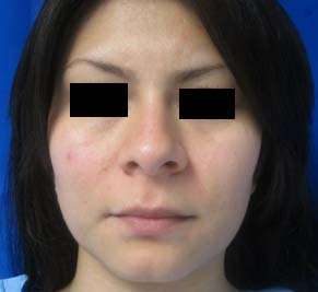 Rhinoplasty Before & After Patient #10261