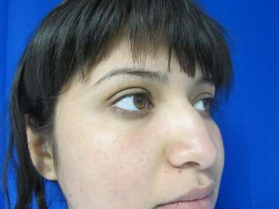 Rhinoplasty Before & After Patient #10264