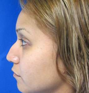 Rhinoplasty Before & After Patient #10269
