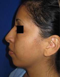 Rhinoplasty Before & After Patient #10272