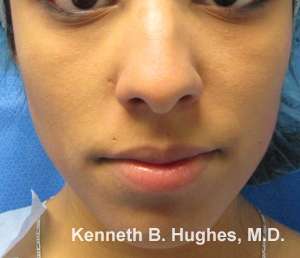 Rhinoplasty Before & After Patient #10277