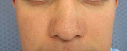 Rhinoplasty Before & After Patient #10283