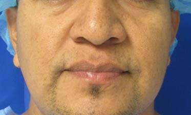 Rhinoplasty Before & After Patient #10288