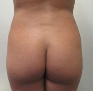 Brazilian Butt Lift Before & After Patient #6342