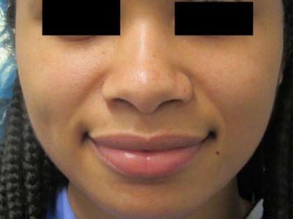 Rhinoplasty Before & After Patient #10296