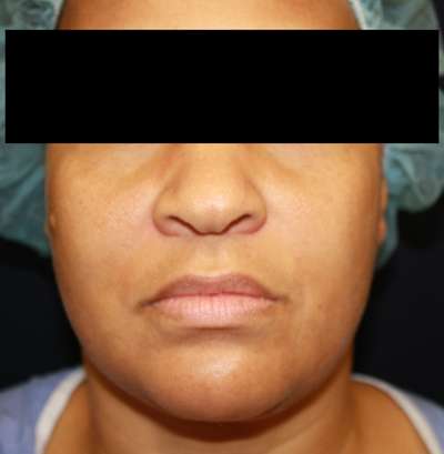 Rhinoplasty Before & After Patient #10299
