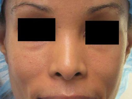 Rhinoplasty Before & After Patient #10318