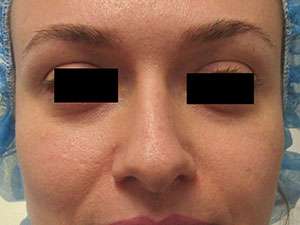 Rhinoplasty Before & After Patient #10321