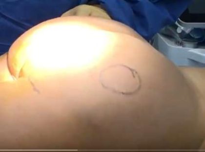Silicone Injections Biopolymer Removal Before & After Patient #10324