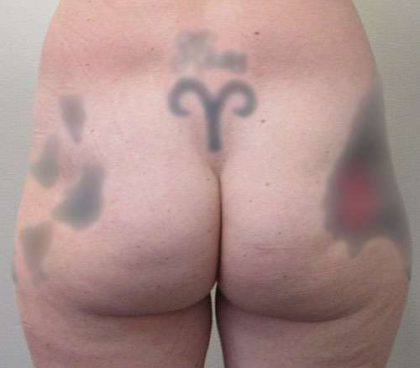 Silicone Injections Biopolymer Removal Before & After Patient #10337