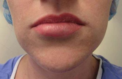 Silicone Injections Biopolymer Removal Before & After Patient #10340