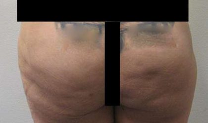 Silicone Injections Biopolymer Removal Before & After Patient #10347