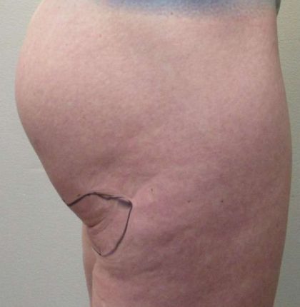 Thigh Lift Before & After Patient #10350