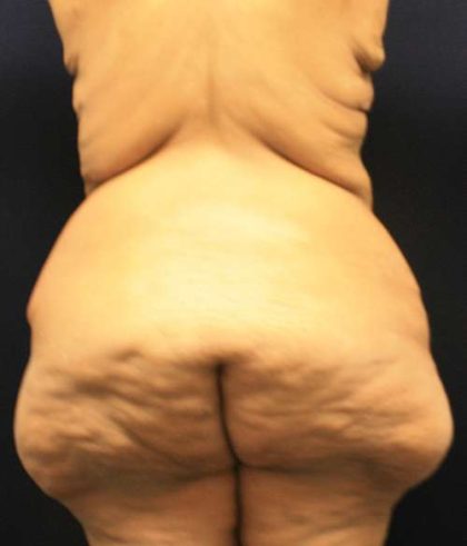 Thigh Lift Before & After Patient #10360