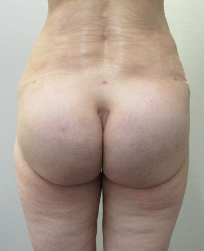 Thigh Lift Before & After Patient #10368