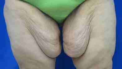 Thigh Lift Before & After Patient #10380