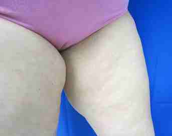 Thigh Lift Before & After Patient #10383