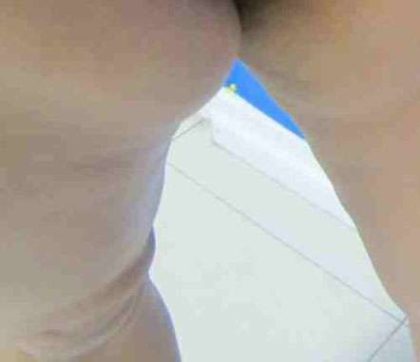 Thigh Lift Before & After Patient #10386