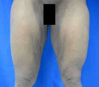 Thigh Lift Before & After Patient #10394