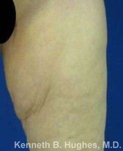 Thigh Lift Before & After Patient #10397