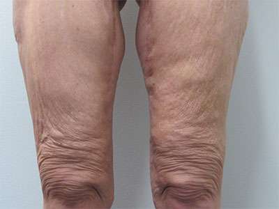Thigh Lift Before & After Patient #10400