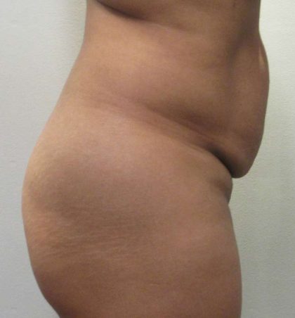 Tummy Tuck Before & After Patient #10410