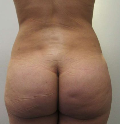 Brazilian Butt Lift Before & After Patient #6358