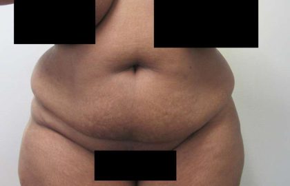 Tummy Tuck Before & After Patient #10418