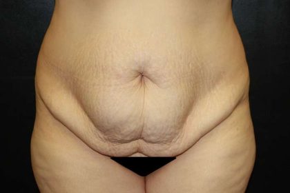 Tummy Tuck Before & After Patient #10423