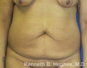 Tummy Tuck Before & After Patient #10447