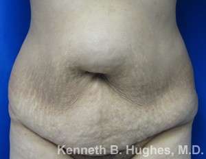 Tummy Tuck Before & After Patient #10456