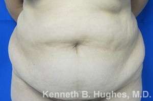 Tummy Tuck Before & After Patient #10459