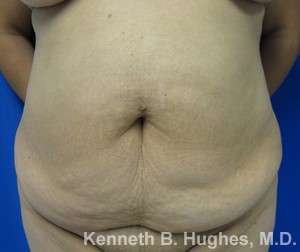 Tummy Tuck Before & After Patient #10462