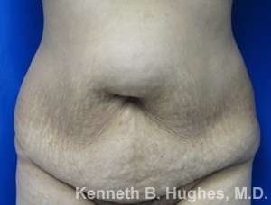Tummy Tuck Before & After Patient #10471