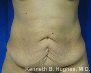 Tummy Tuck Before & After Patient #10474